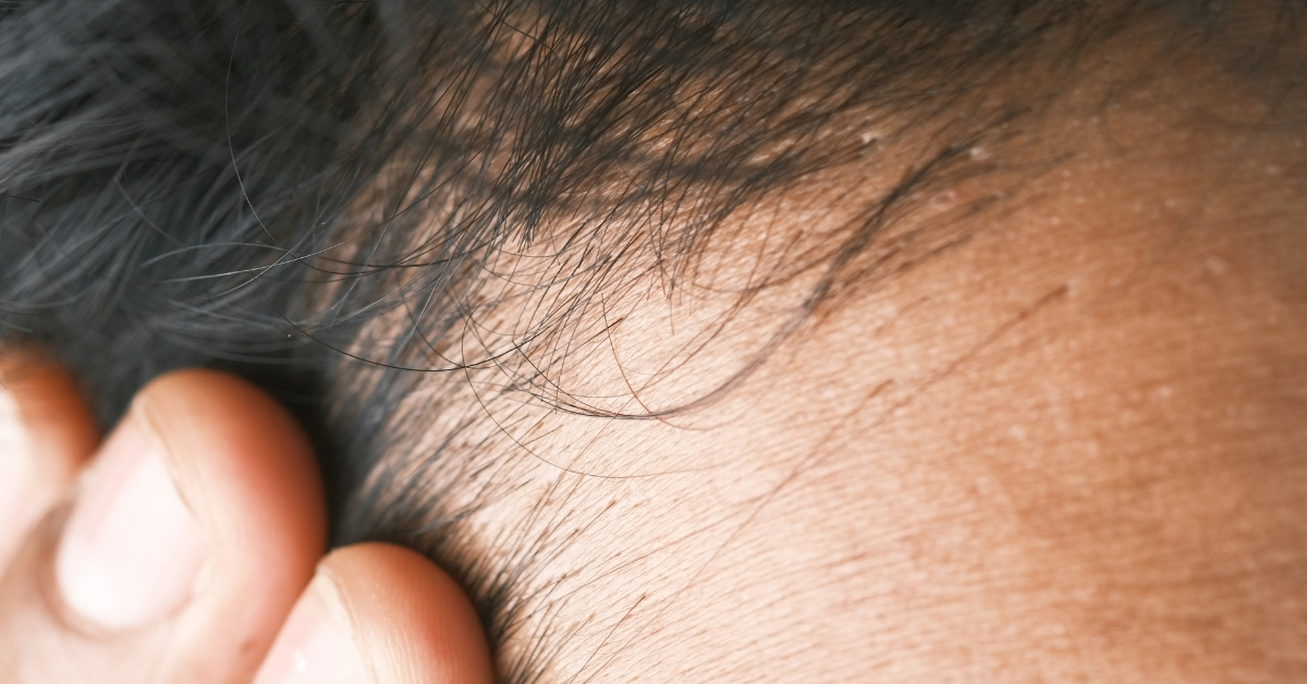 Finasteride Hair Loss Treatment