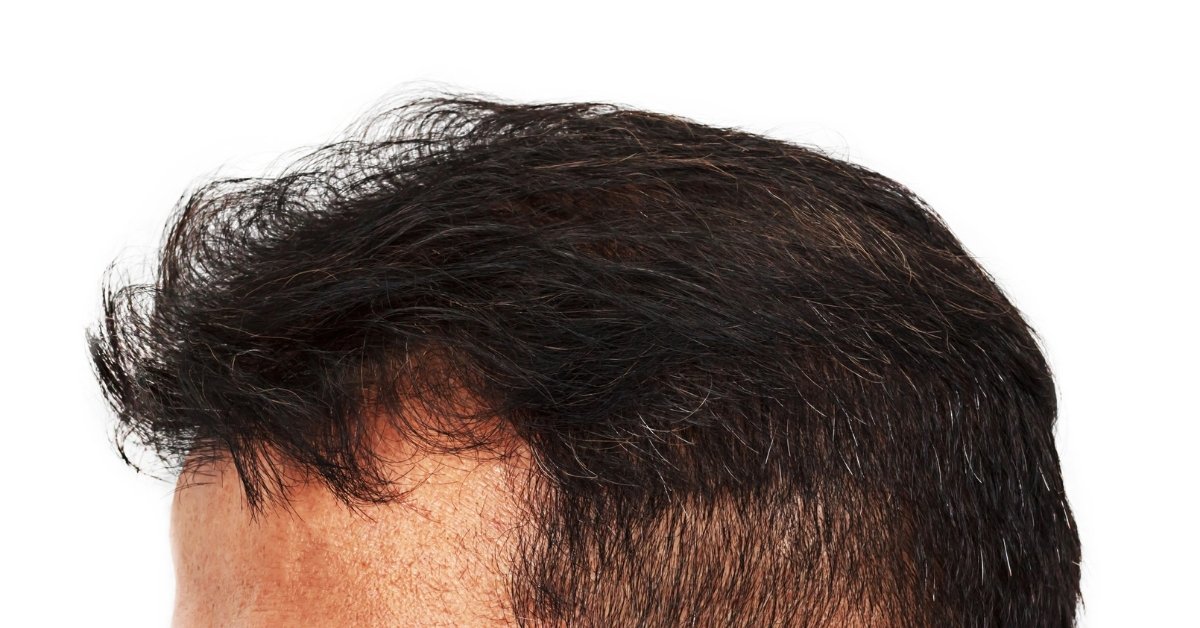 Dutasteride For Men's Hair Loss