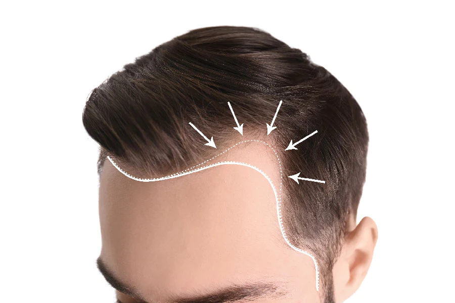 How to Stop A Receding Hairline
