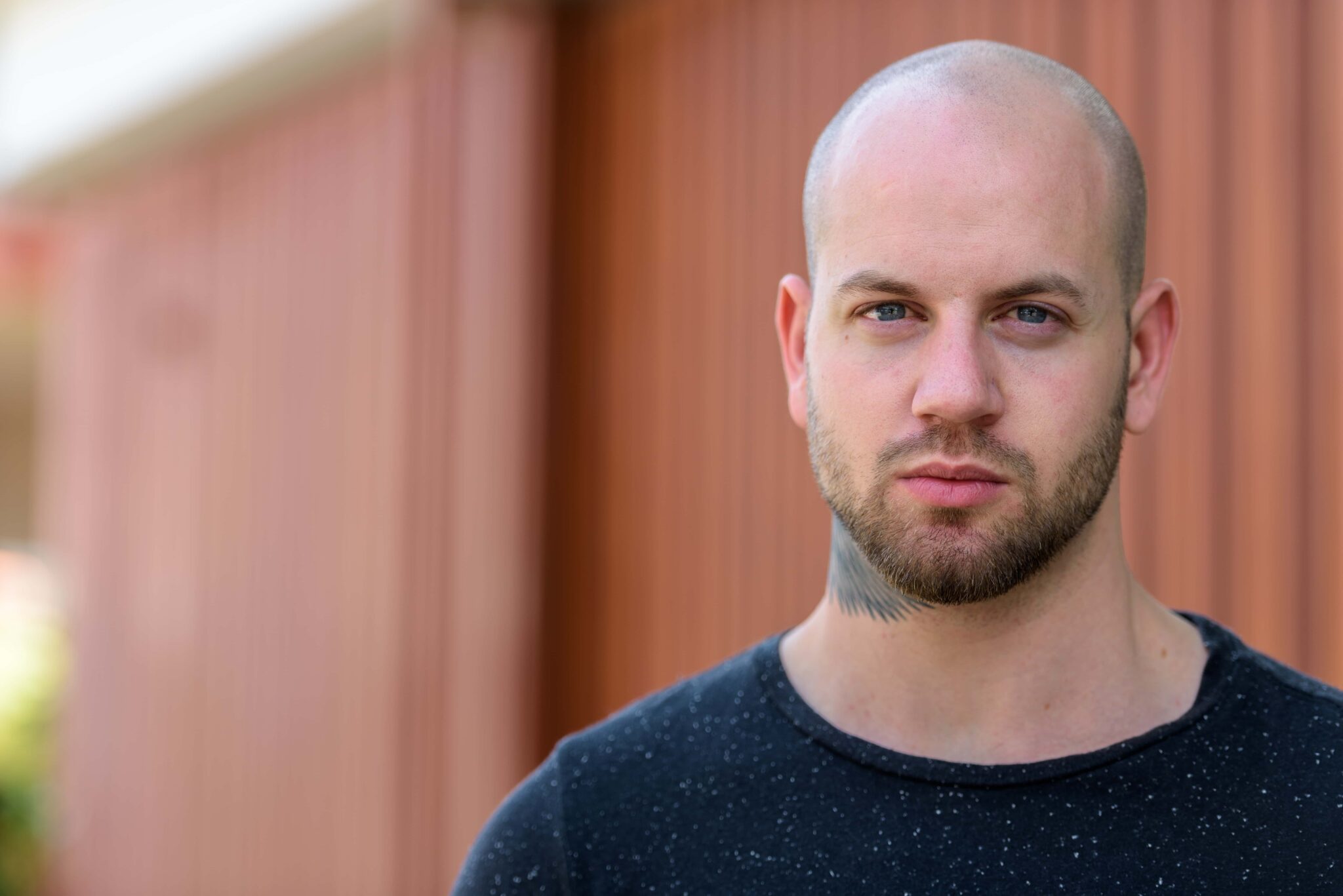 Signs of Balding at 20 Understanding Hair Loss Evolve