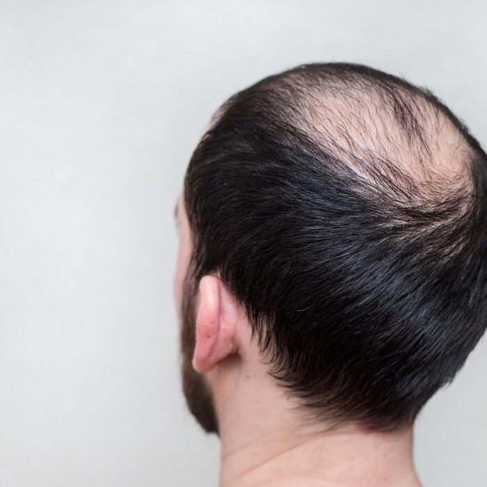 signs of balding at 20