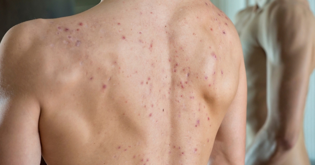 Back acne that may occur as a side effect of testosterone replacement therapy