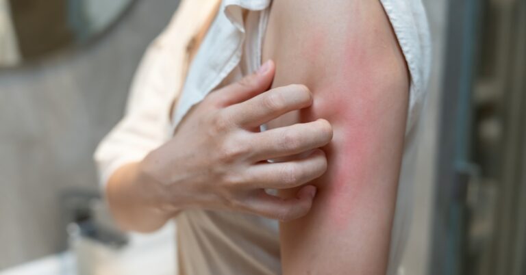 Woman experiencing itchy skin during menopause